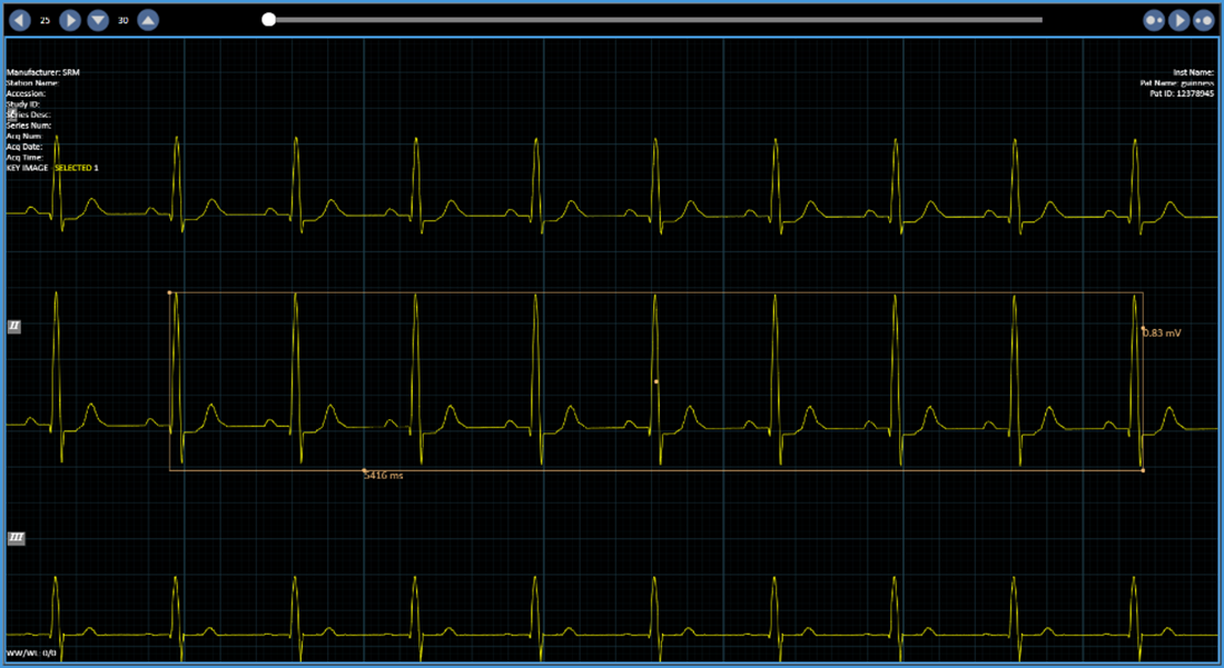 ECG2