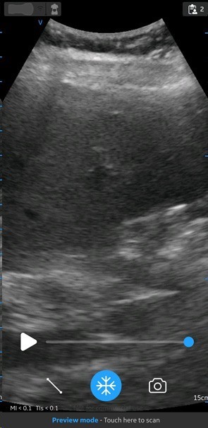 Abdominal Preset with Curved
